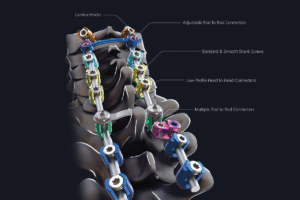 stahlmann pro - Spine Implants | Innovative Orthopedic Solutions -