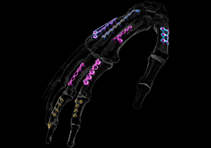 stahlmann pro - Stahlmann Pro | Surgical, Spine & Trauma Implants Manufacturer -