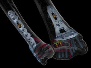 stahlmann pro - Trauma Implants | Bone Screws, Plates & Fixation Systems -