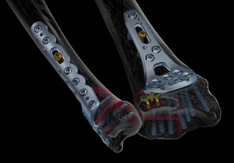 stahlmann pro - Stahlmann Pro | Surgical, Spine & Trauma Implants Manufacturer -