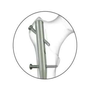 Expert Femur Nail Dynamic-Locking