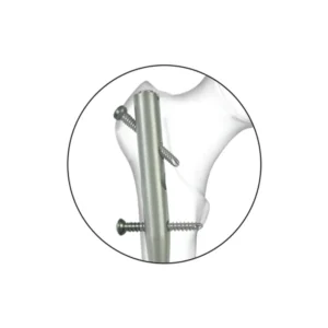 Expert Femur Nail Proximal-nail-locking-hole-detail