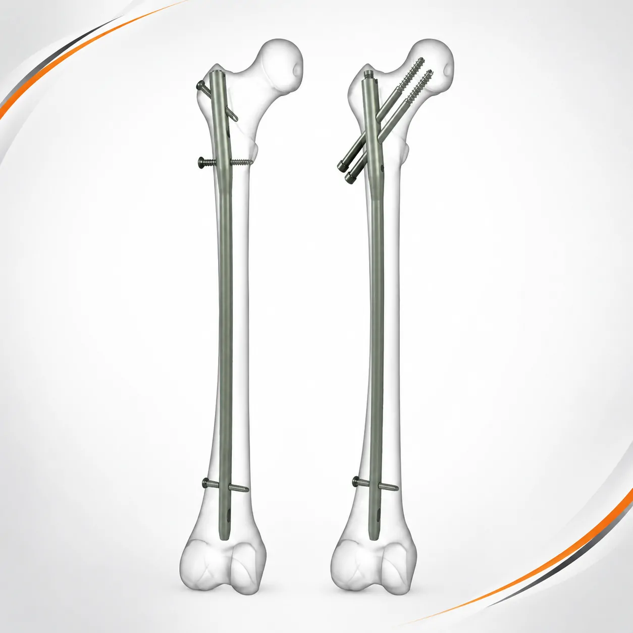 Expert Femur Nail: 7 Essential Facts About Femur Fixation Standard and reconstructed femurs, side by side